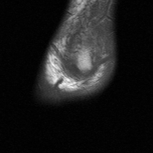 File:Anterior talofibular ligament rupture (Radiopaedia 15831-15484 Sagittal T1 1).jpg