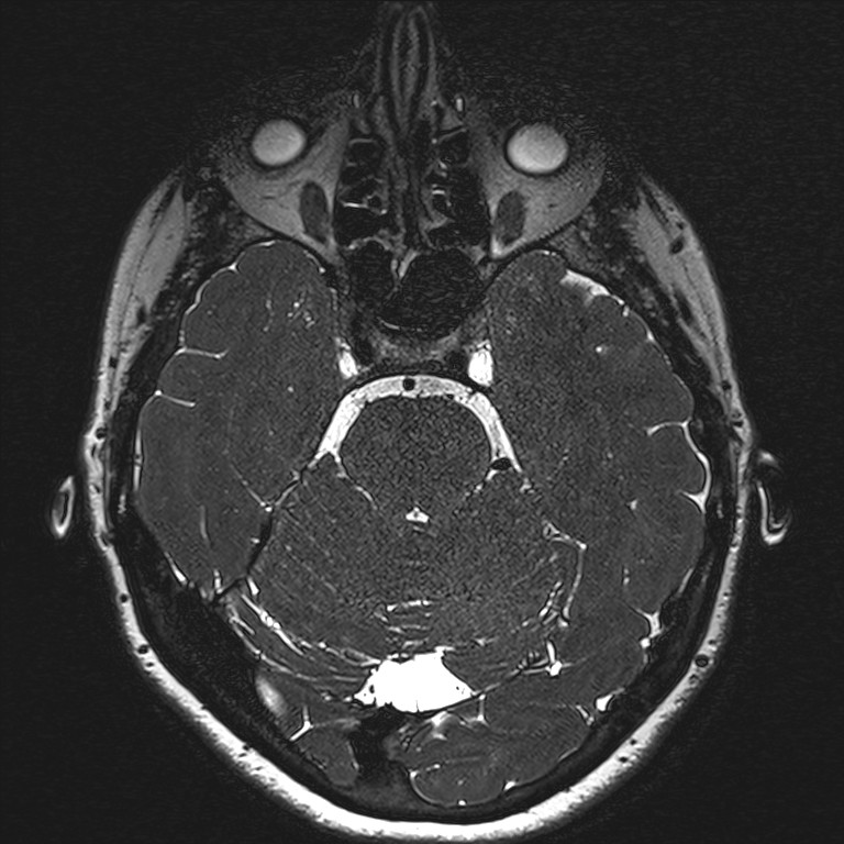 Anterior temporal encephalocele (Radiopaedia 82624-96808 Axial T2 high res 53).jpg