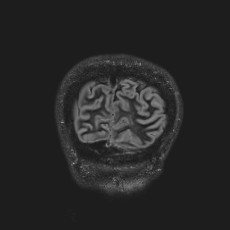 Anterior temporal encephalocele (Radiopaedia 82624-96808 Coronal FLAIR 50).jpg
