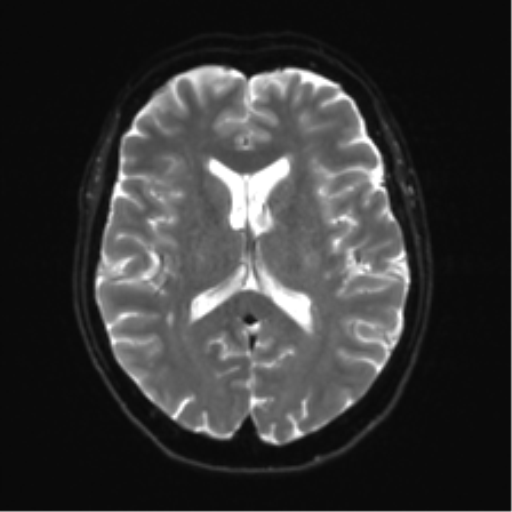 Anterior temporal lobe perivascular space (Radiopaedia 40946-43650 Axial DWI 15).png