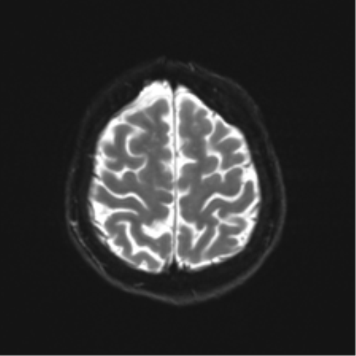 Anterior temporal lobe perivascular space (Radiopaedia 40946-43650 Axial DWI 23).png