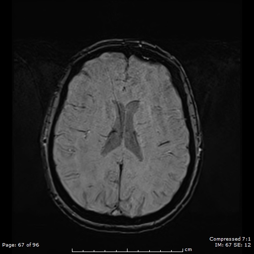 File:Anterior temporal lobe perivascular space (Radiopaedia 88283-104914 Axial SWI 36).jpg