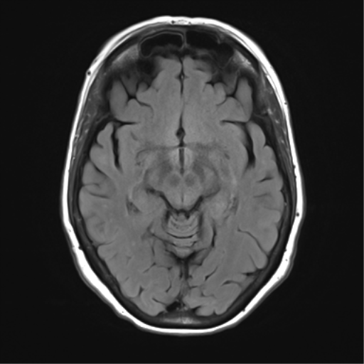 File:Anterior temporal pole cysts (Radiopaedia 46629-51102 Axial FLAIR 12).png