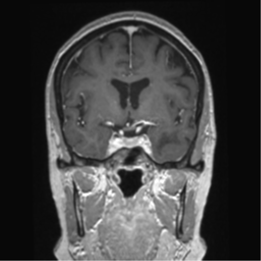 Anterior temporal pole cysts (Radiopaedia 46629-51102 Coronal T1 C+ 105).png