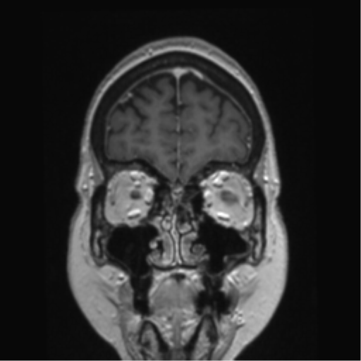 Anterior temporal pole cysts (Radiopaedia 46629-51102 Coronal T1 C+ 146).png