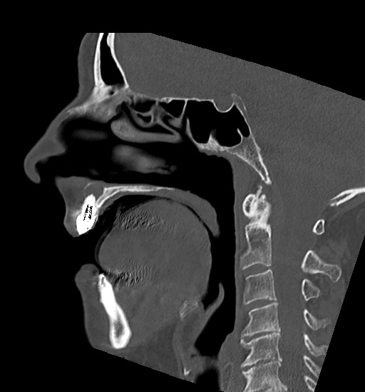 Anterior temporomandibular joint dislocation (Radiopaedia 59430-66784 B 29).jpg