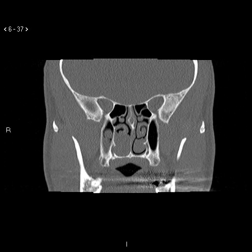 File:Antrochoanal Polyp (Radiopaedia 70510-80631 Coronal bone window 26).jpg