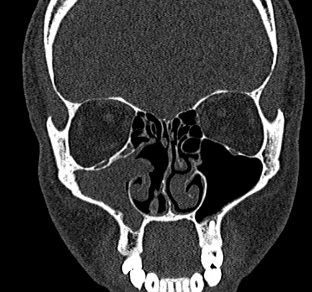 Antrochoanal polyp (Radiopaedia 30002-30554 Coronal bone window 34).jpg