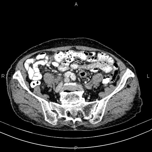 File:Aortic aneurysm and Lemmel syndrome (Radiopaedia 86499-102554 A 58).jpg