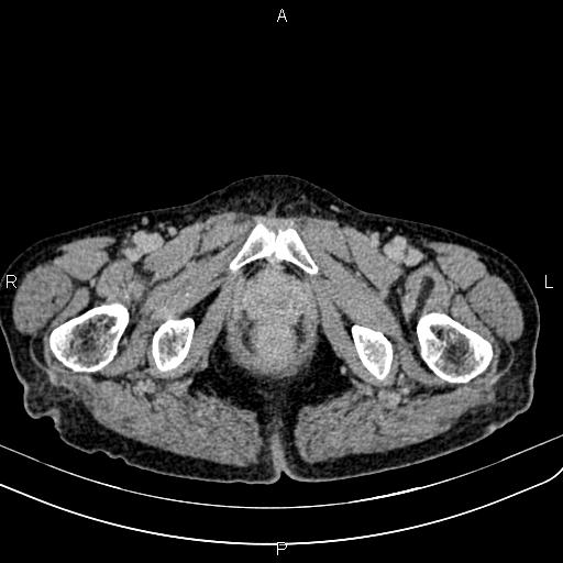 File:Aortic aneurysm and Lemmel syndrome (Radiopaedia 86499-102554 Axial C+ delayed 82).jpg