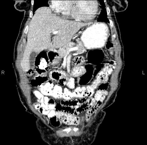 Aortic aneurysm and Lemmel syndrome (Radiopaedia 86499-102554 C 15).jpg