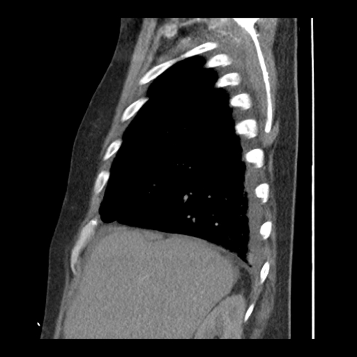 Aortic arch graft infection (FDG PET-CT) (Radiopaedia 71975-82437 C 13).jpg