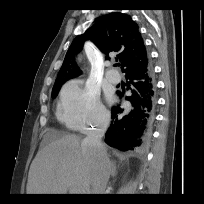 Aortic arch graft infection (FDG PET-CT) (Radiopaedia 71975-82437 C 25).jpg