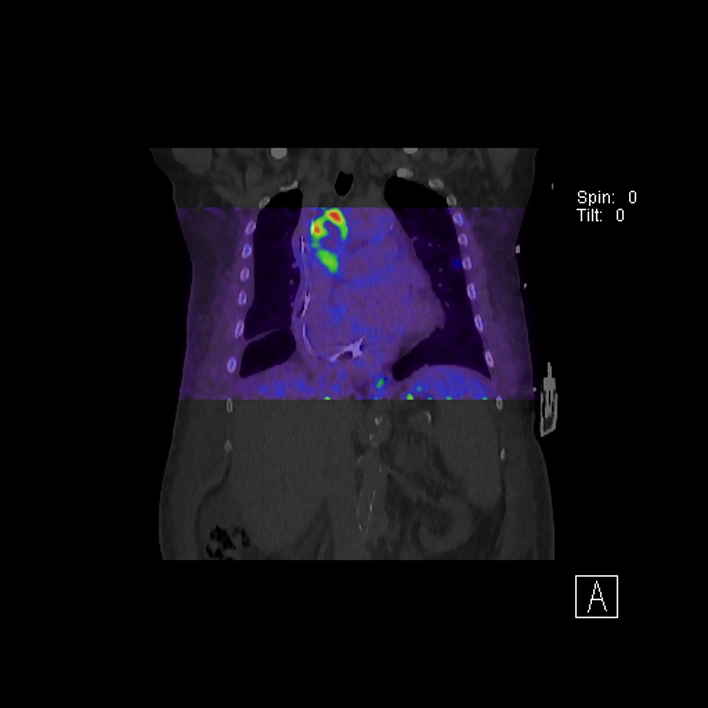 Aortic arch graft infection (FDG PET-CT) (Radiopaedia 71975-82438 D 42).jpg