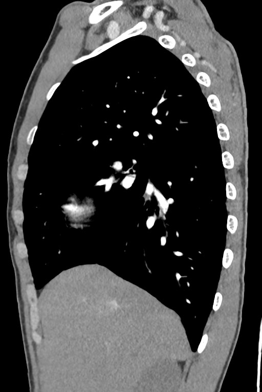 Aortic coarctation with aneurysm (Radiopaedia 74818-85828 B 49).jpg