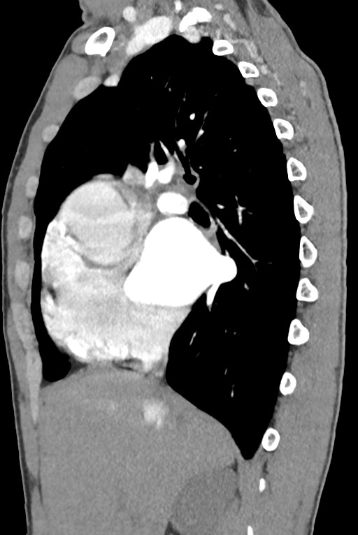 Aortic coarctation with aneurysm (Radiopaedia 74818-85828 B 62).jpg