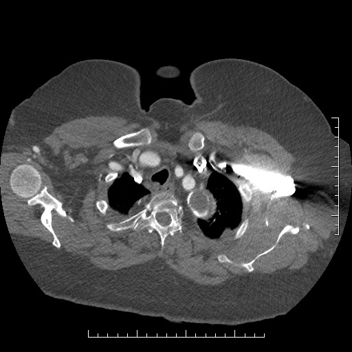 File:Aortic dissection- Stanford A (Radiopaedia 35729-37268 A 4).jpg