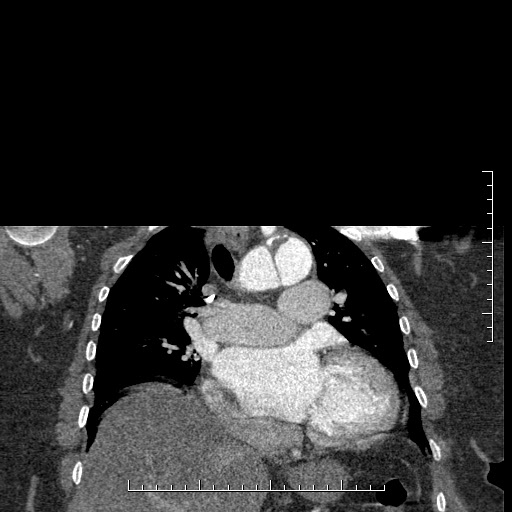 Aortic dissection- Stanford A (Radiopaedia 35729-37268 E 31).jpg