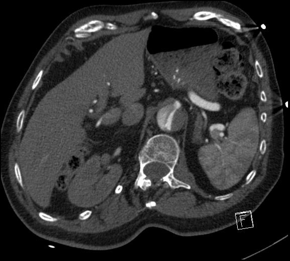 Aortic dissection (CTPA) (Radiopaedia 75506-86750 A 93).jpg