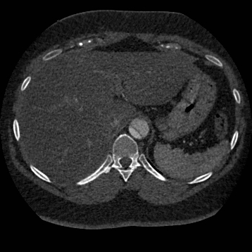 File:Aortic dissection (Radiopaedia 57969-64959 A 293).jpg