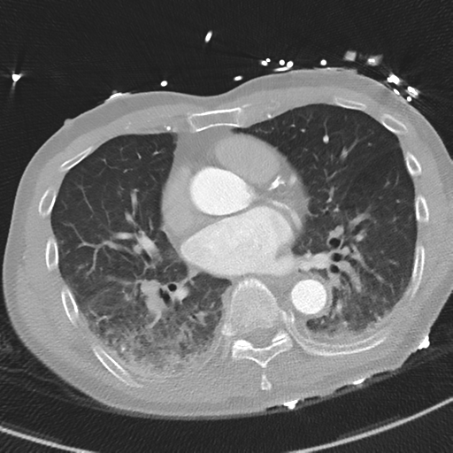Aortic dissection - DeBakey type II (Radiopaedia 64302-73082 Axial lung window 36).png