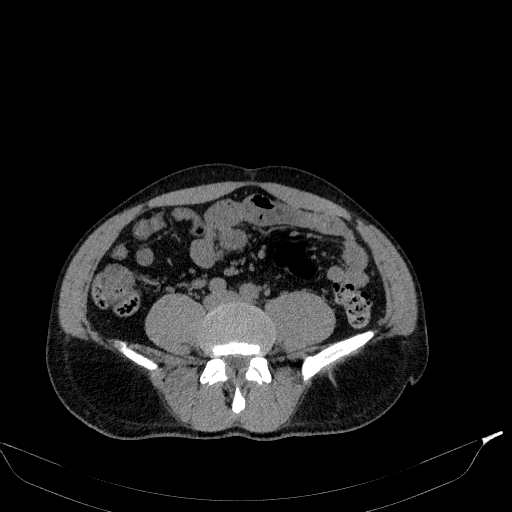 Aortic dissection - Stanford type A (Radiopaedia 83418-98500 Axial non-contrast 67).jpg