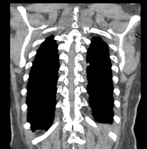 File:Aortic dissection - Stanford type B (Radiopaedia 50171-55512 B 72).png