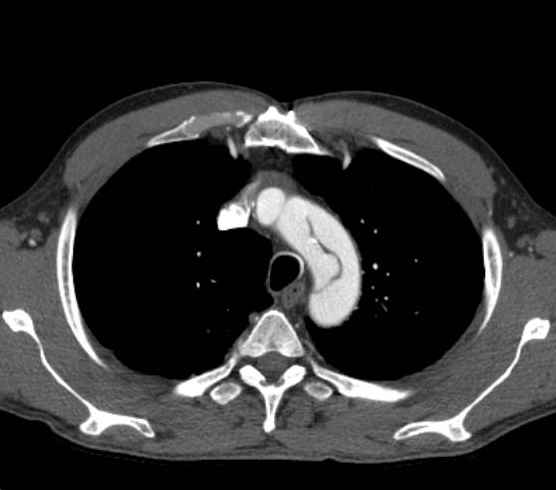 Aortic dissection - Stanford type B (Radiopaedia 73648-84437 A 16).jpg