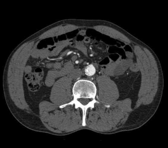 Aortic dissection - Stanford type B (Radiopaedia 73648-84437 A 174).jpg