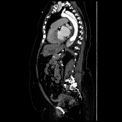 File:Aortic dissection - Stanford type B (Radiopaedia 88281-104910 C 49).jpg