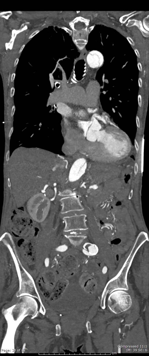 Aortic dissection with extension into aortic arch branches (Radiopaedia 64402-73204 A 38).jpg