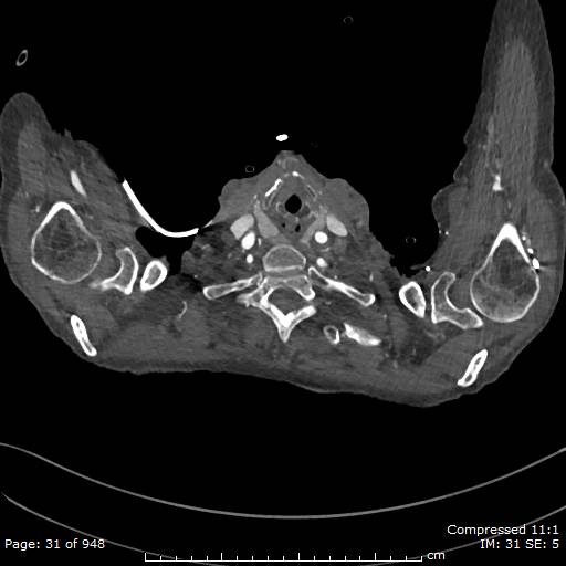 Aortic dissection with extension into aortic arch branches (Radiopaedia 64402-73204 B 31).jpg