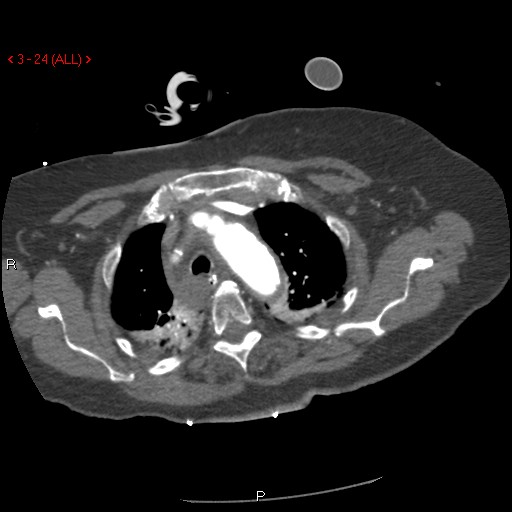 Aortic intramural hematoma (Radiopaedia 27746-28001 A 24).jpg