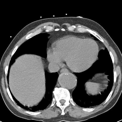 Aortic intramural hematoma (Radiopaedia 31139-31838 Axial non-contrast 41).jpg