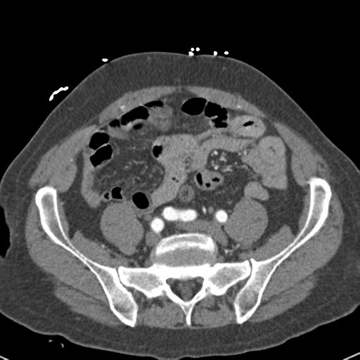 File:Aortic intramural hematoma (Radiopaedia 31139-31838 B 134).jpg