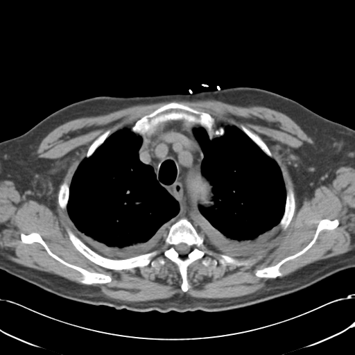 Aortic intramural hematoma (Radiopaedia 34260-35540 Axial non-contrast 14).png