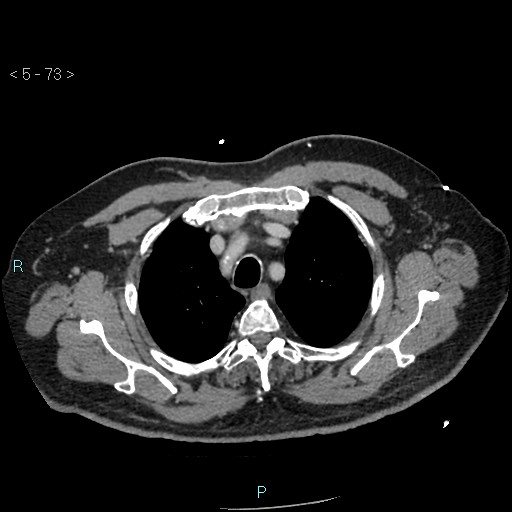 Aortic intramural hematoma (Radiopaedia 48463-53380 C 33).jpg