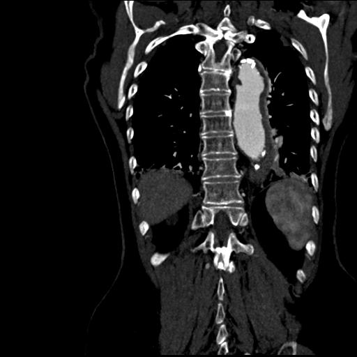 File:Aortic intramural hematoma from penetrating atherosclerotic ulcer (Radiopaedia 31137-31836 C 53).jpg