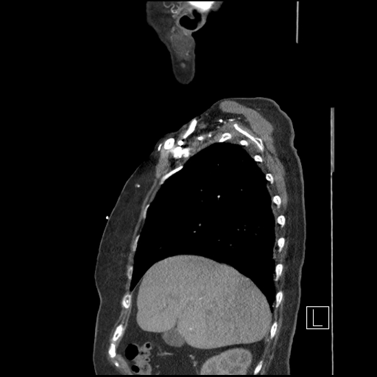 File:Aortic intramural hematoma with dissection and intramural blood pool (Radiopaedia 77373-89491 D 19).jpg