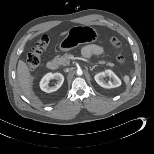 Aortic transection, diaphragmatic rupture and hemoperitoneum in a complex multitrauma patient (Radiopaedia 31701-32622 A 98).jpg