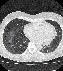 File:Aortic valve endocarditis (Radiopaedia 87209-103485 Axial lung window 66).jpg