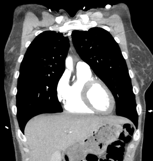 Aortic valve non-coronary cusp thrombus (Radiopaedia 55661-62189 C 24).png