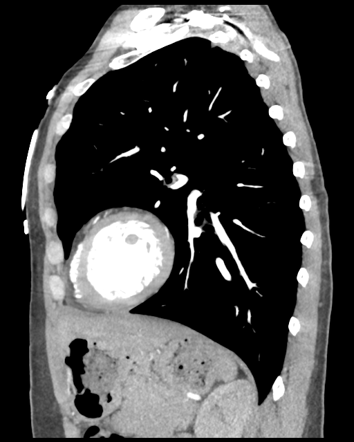 Aortic valve non-coronary cusp thrombus (Radiopaedia 55661-62189 D 19).png