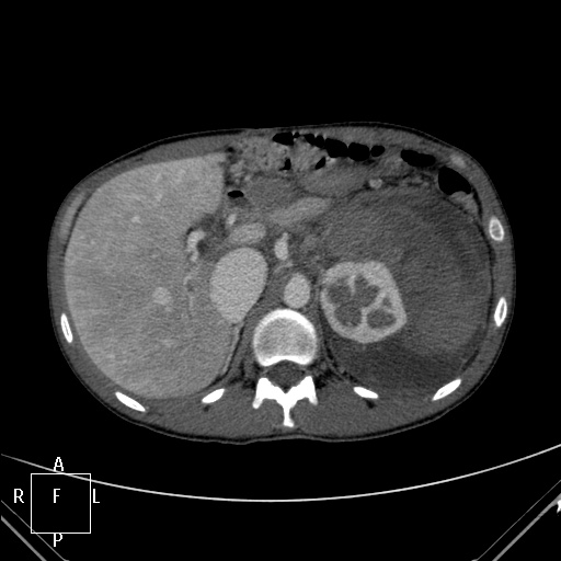 File:Aorto-left renal vein fistula (Radiopaedia 45534-49628 A 7).jpg