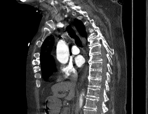 File:Aortoesophageal fistula with endovascular repair (Radiopaedia 73781-84592 Sagittal C+ CTPA 91).jpg