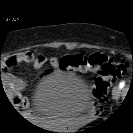Aortoiliac occlusive disease (Radiopaedia 16828-16548 A 86).jpg