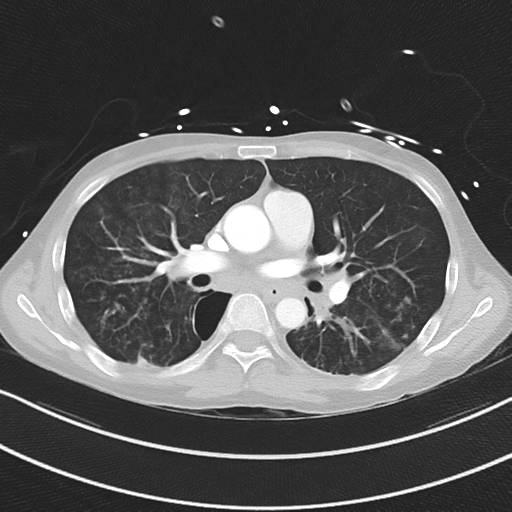 Apical bullous disease in a heavy smoker (Radiopaedia 33067-34092 Axial lung window 32).png
