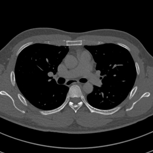 Apical lung mass mimic - neurogenic tumor (Radiopaedia 59918-67521 Axial bone window 35).jpg