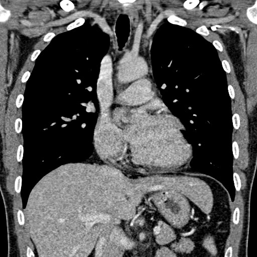 Apical lung mass mimic - neurogenic tumor (Radiopaedia 59918-67521 B 59).jpg