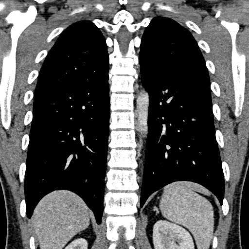 Apical lung mass mimic - neurogenic tumor (Radiopaedia 59918-67521 B 79).jpg